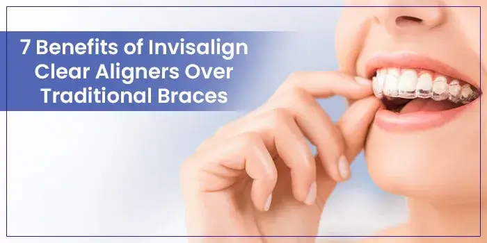 7 Benefits of Invisalign Clear Aligners Over Traditional Braces