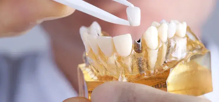 Dental Implants services in Bikaner
