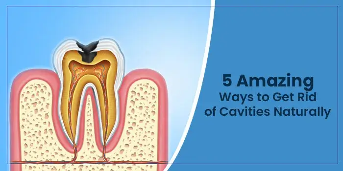 5 Amazing Ways to Get Rid of Cavities Naturally