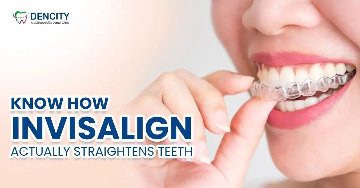 Invisible Braces For Teeth Gap: Know How Invisalign Actually Straightens Teeth