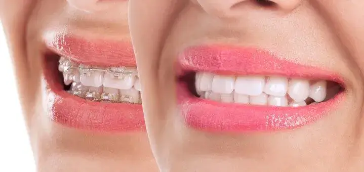 What are the Reasons for Orthodontic Treatment?