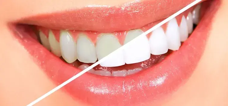 Teeth Whitening Treatment in Bikaner