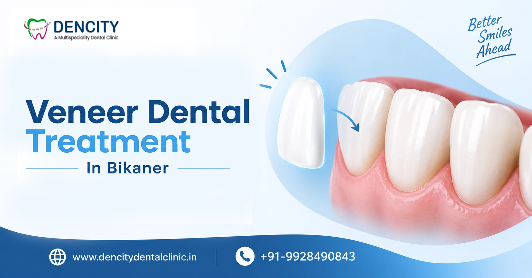 Veneer Dental Treatment In Bikaner - Veneer Dentist In Bikaner