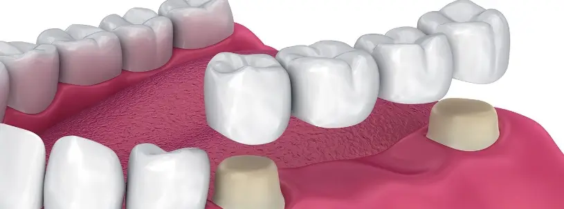 Tooth Or Dental Bridge Treatment