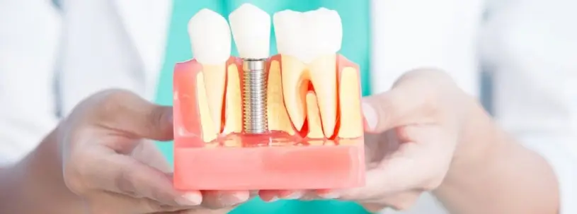 Dental Implants