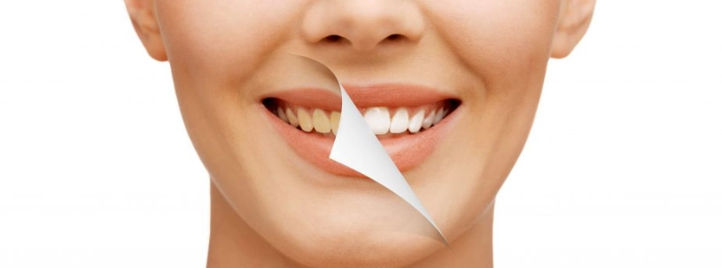 Teeth Whitening & Cleaning